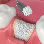 3D representation of Bone Grafting