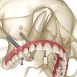 3D representation of Zygoma/Pterygoid Implants