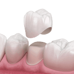 Dental crown