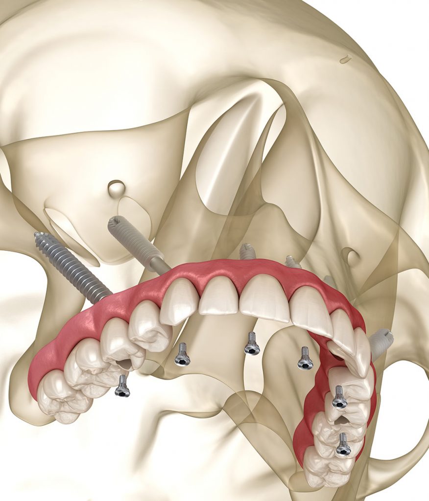 3D representation of Zygoma/Pterygoid Implants