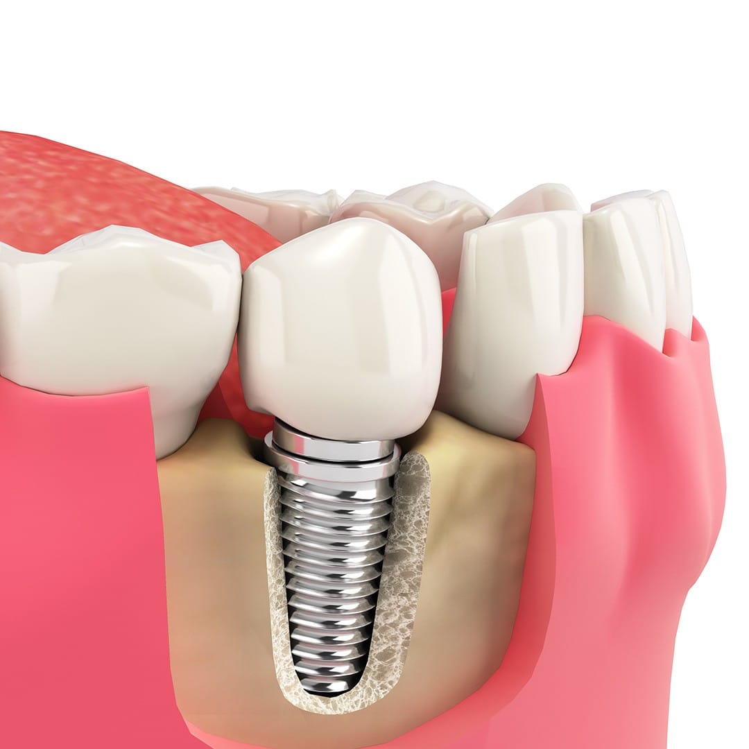 Individual Inplants Dental Implants - Star Dental Implants
