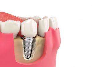 3D representation of dental implants