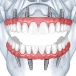 3D representation of dental implants