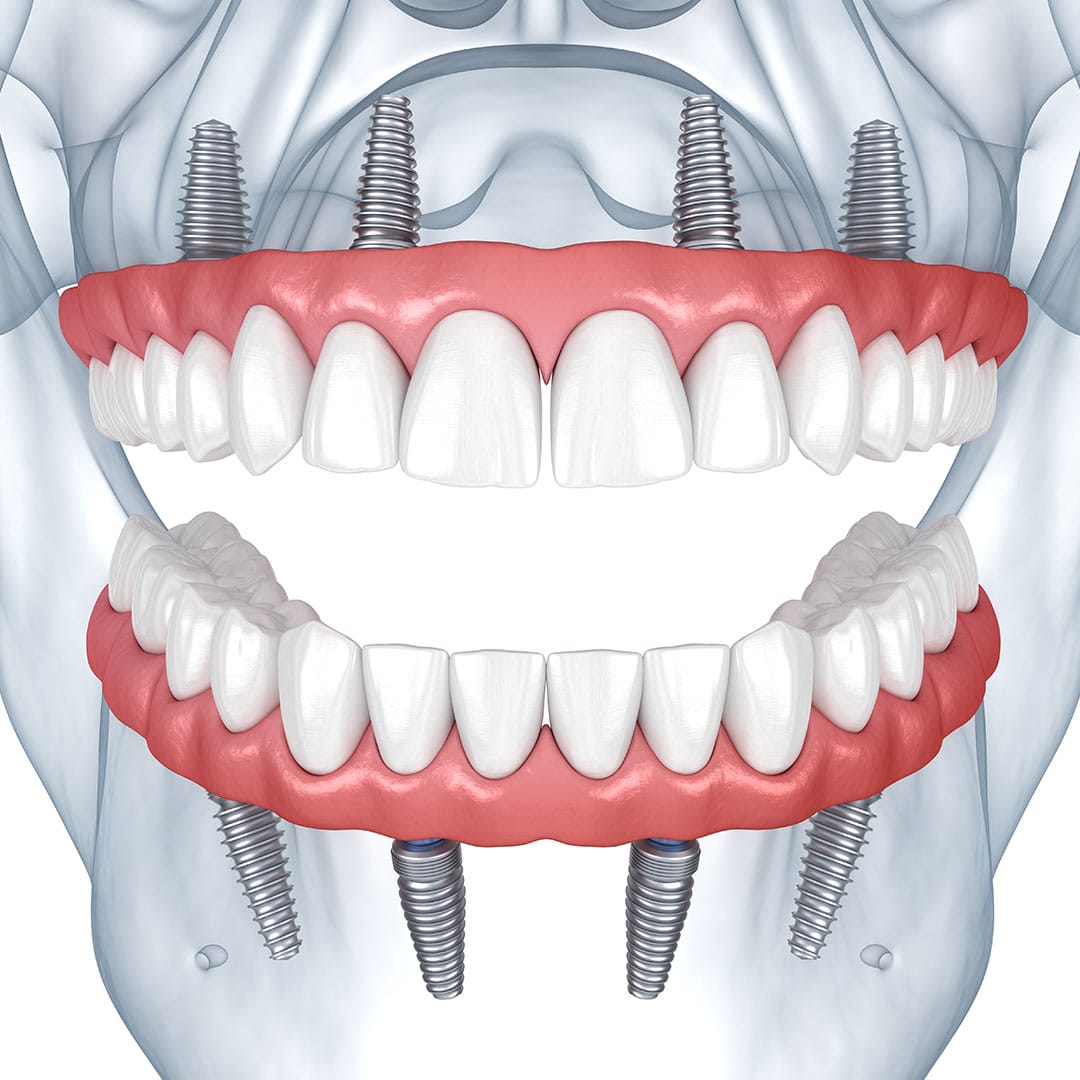 Allon4, 5 or 6 Star Dental Implants