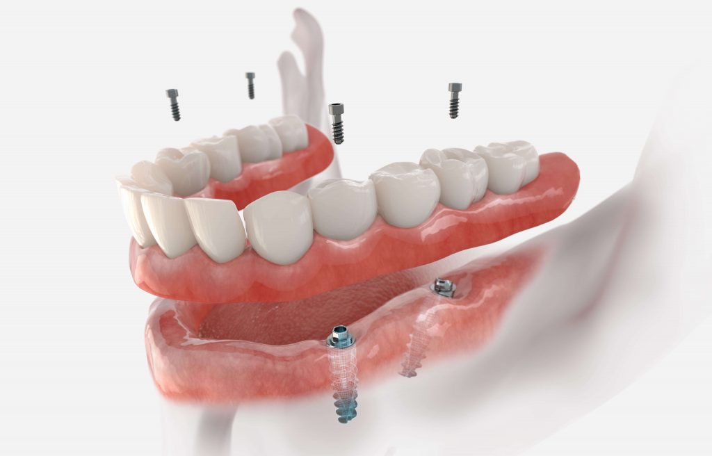 3D representation of dental implants