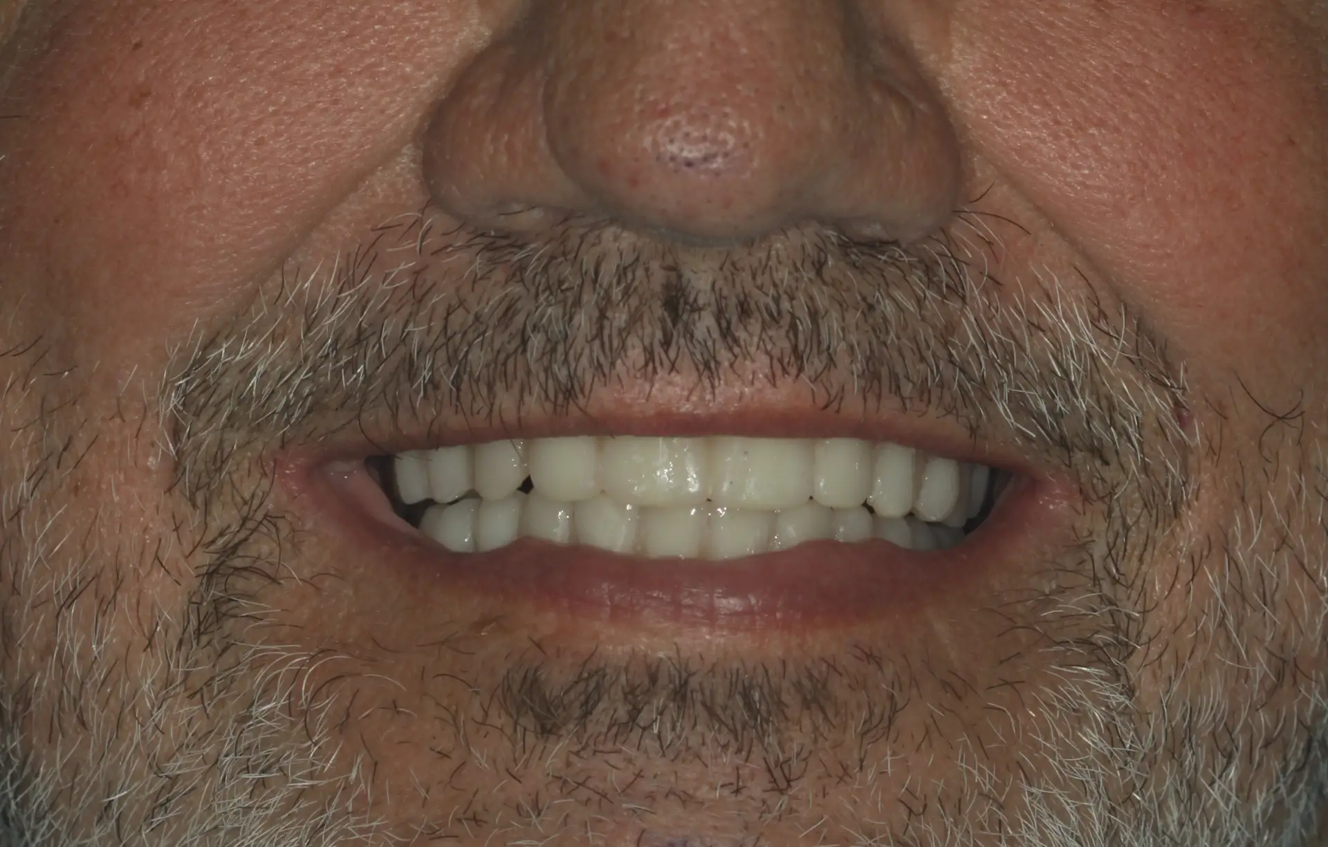 Dave C's dental transformation - after receiving lower and upper All On 4 dental implants