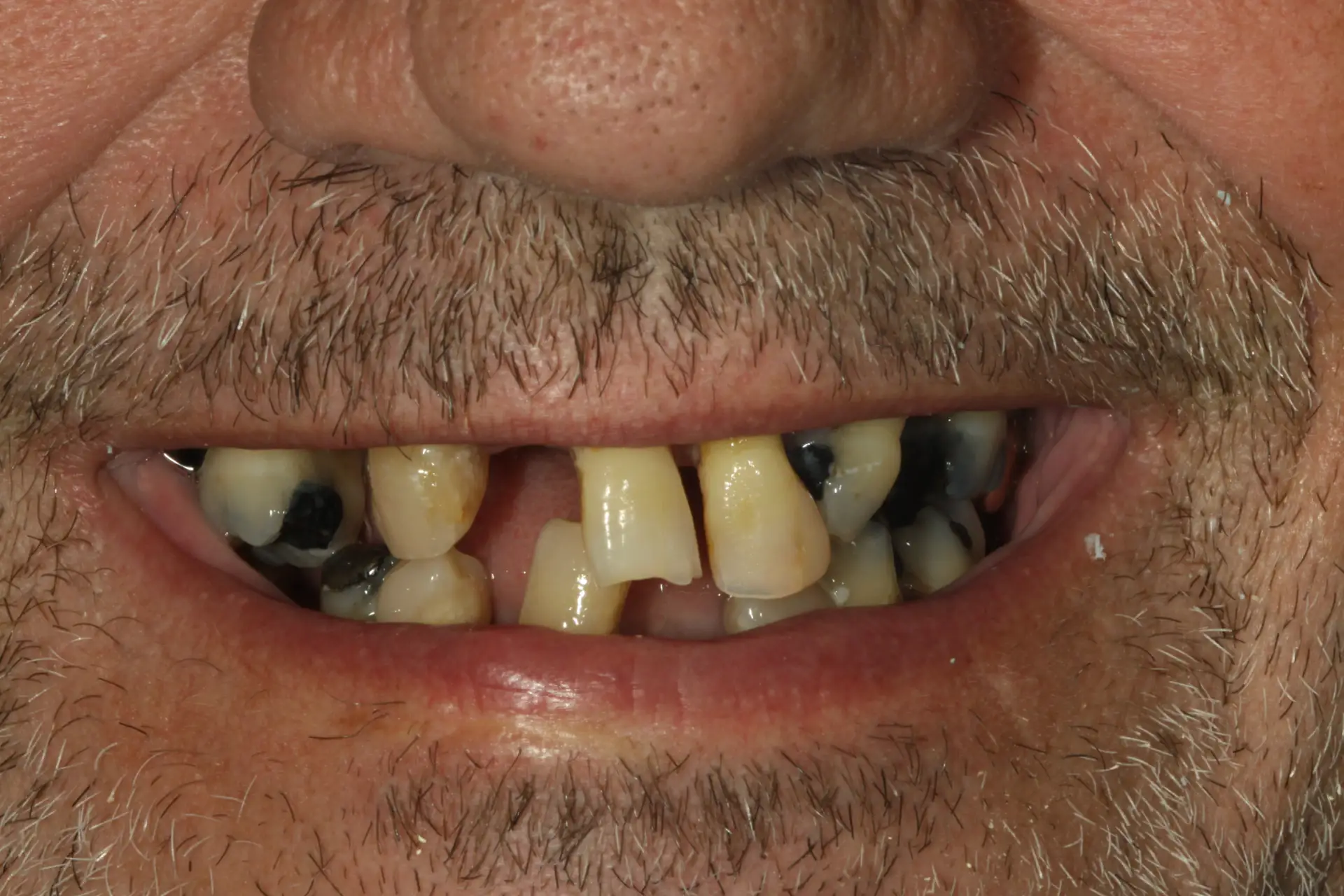 Dave C's dental condition before receiving All On 4 implants