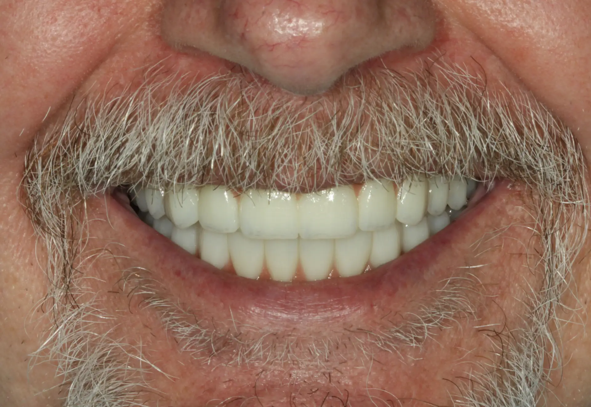 Raymond A's smile after receiving upper All On 4 and lower All On 6 zirconia implants