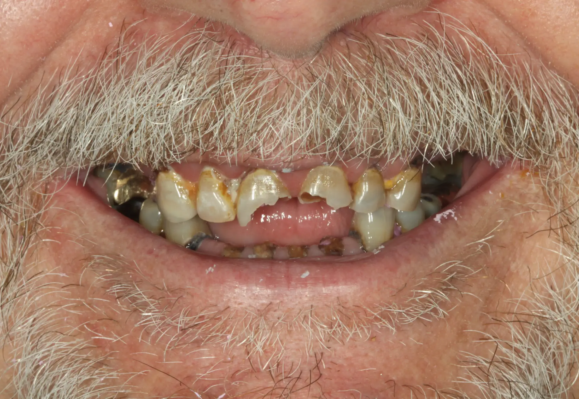 Raymond A's dental condition before receiving zirconia implants